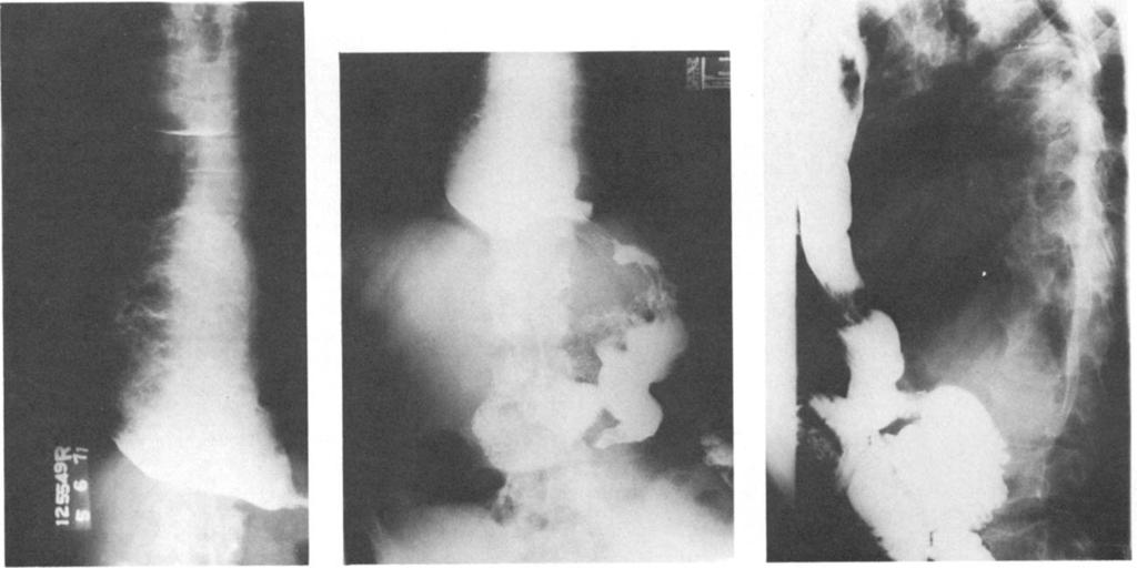 204 The Annals of Thoracic Surgery Vol 38 No 3 September 1984 A B C Fig 4. (A) Preoperative barium esophagogram shows findings consistent with achalasia.