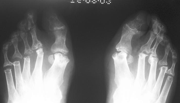 750 Fig. 1-A Standing preoperative anteroposterior radiograph showing the typical deformities found in the rheumatoid forefoot.