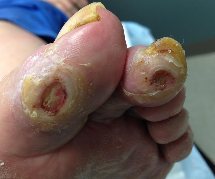 Plantar Hallux IPJ Ulcer Causes - hallux limitus/rigidus, equinus Treatment - Keller arthroplasty Clinical efficacy of the first MTPJ arthroplasty as a curative procedure for hallux IPJ wounds in