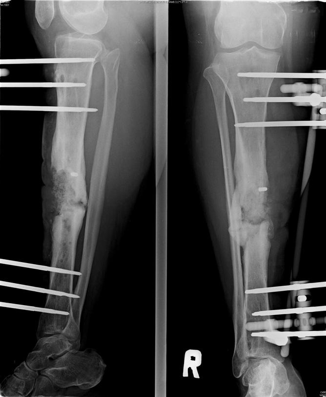 Partial weight bearing with crutch assistance was recommended for 4 weeks after which full weight bearing was encouraged.