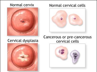 Cervical cancer usually develops very slowly.