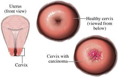 This precancerous condition can be detected by a pap smear and is