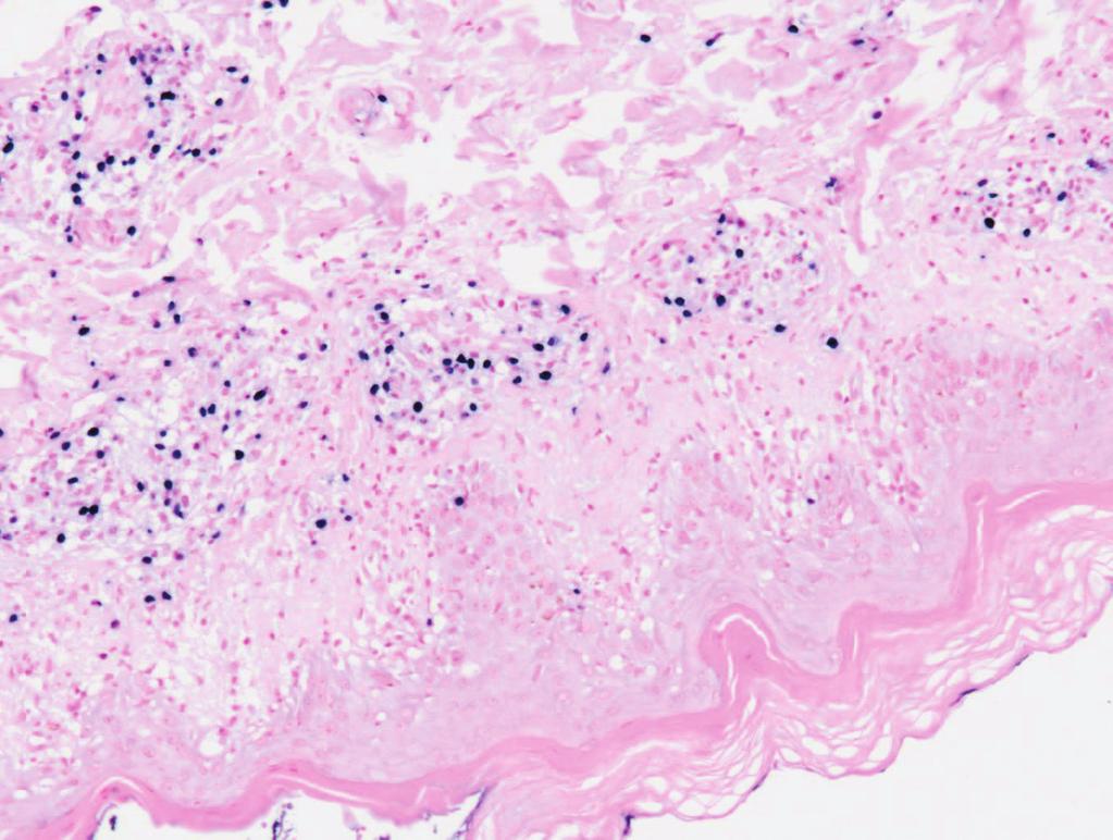 136 J. H. Tsai et al./jcrp 27(2011) 133-137 Figure 3. EBER stain of skin biopsy showed strongly positive staining. (100X magnification) Figure 4.