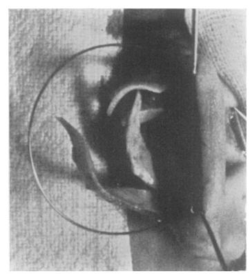 Operation on the right ear showing the skin capsule retracted. The cartilage has been cut into serrations.