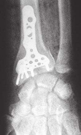 Matthee W, et al. SAOJ 2017;16(3) Page 63 to discharge, however, formal radiographs at our institution are routinely taken perpendicular to the wrist joint.