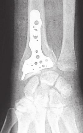 Tilted views tangential to the joint allow for evaluation of the radiocarpal joint without the overlying bone shadow of the radial styloid on the lateral view and the dorsal rim of the distal radius
