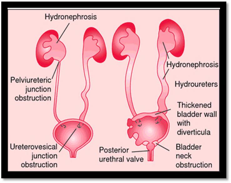 Technically, hydronephrosis specifically describes dilation and swelling of the kidney, while the term hydroureter is used to describe swelling of the ureter.