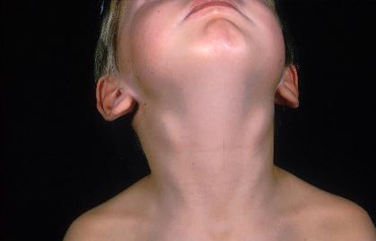 1 The Neck Lymph nodes are common in the neck Rarely require