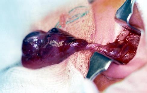 3 The testes Testicular torsion in neonates Hemi-scrotal