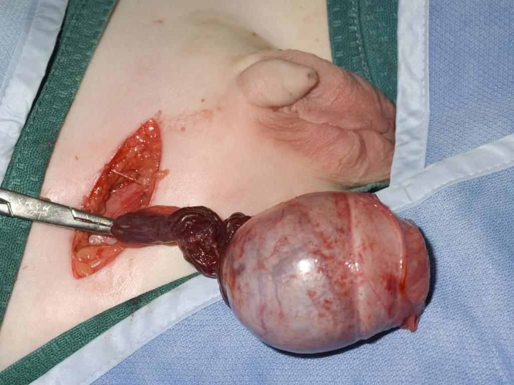 sac tumour removed