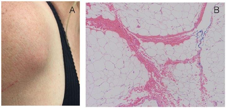 Lacroix and Wang 59 Figure 5. (A) Subcutaneous nodule of anterior shoulder.