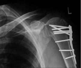 The patient had partial axillary nerve injury with partial axonal degeneration 12 presented with fractures of the proximal humerus were treated by open reduction and internal fixation using locked