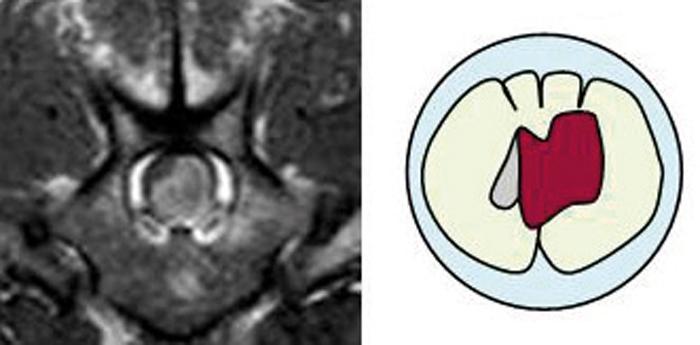 Figure 3. Spinal neoplasia. A: normal spinal cord.
