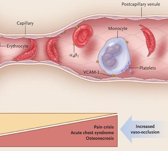 What are the vaso-occlusive manifestations of SCD?
