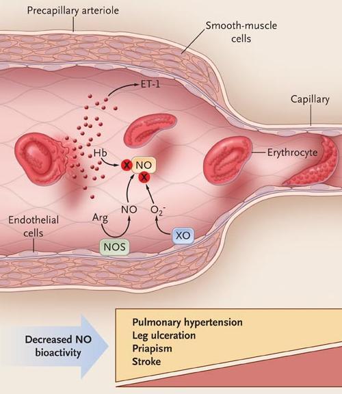 What are the hemolytic manifestations of SCD?