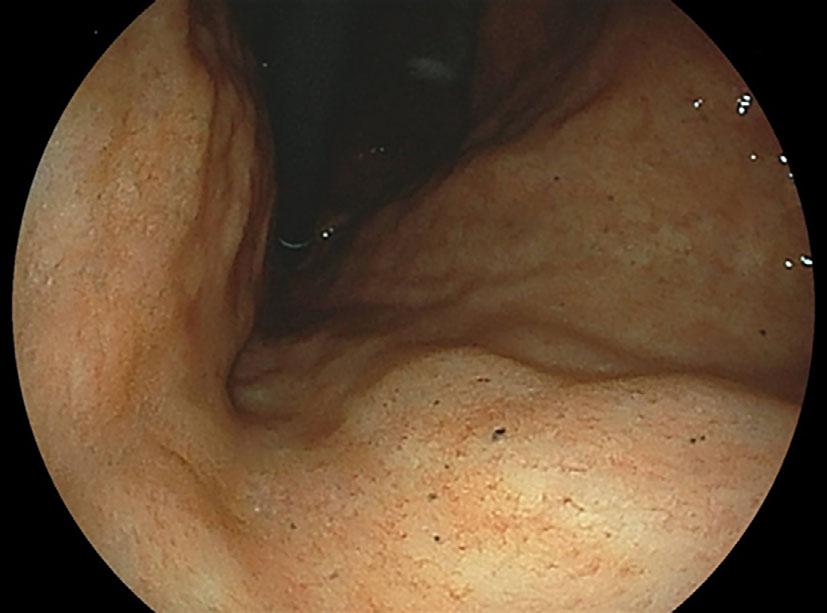 Figure 1. Representative case. A 68-year-old man who underwent eradication therapy for H. pylori 5 years prior to the examination. Endoscopy revealed multiple black spots in the body of the stomach.