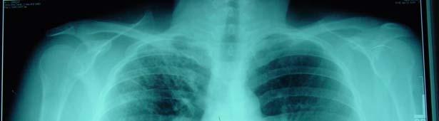 Evaluation of a B1 Refugee Young woman from Uzbekistan TST positive Abnormal CXR prior