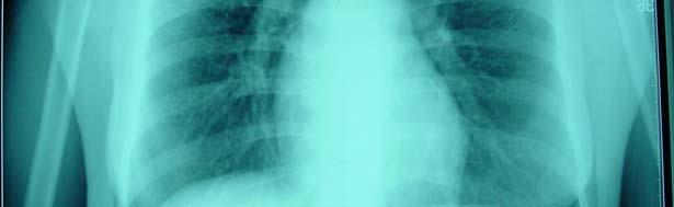 tuberculosis Denies prior treatment for tuberculosis Husband and 2 young children also