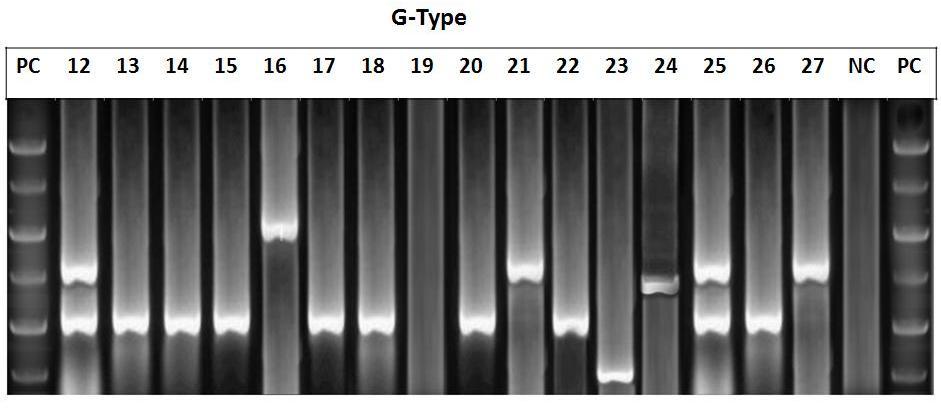 5%) and G9 (2.5%). Chakravarti et al 2010 found similar result of genotype. They observed G1 (60%), followed by G2 (16%),G3 (3%) and G9 (8%). About the P type identified in our study were P[4] (27.
