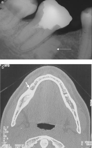 Advanced radiographic techniques for the detection of lesions in bone Fig. 8. Radiopaque bone lesion in the mesial periradicular area of the lower left second molar.