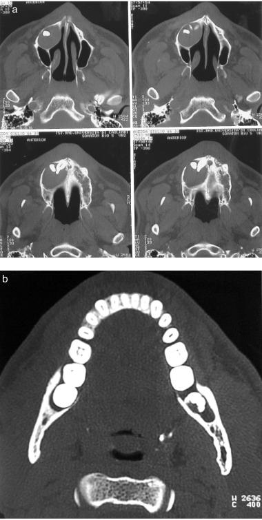 Cotti & Campisi Fig. 10. Computerized tomography (CT) examination of a dentigerous cyst of the left maxilla and of the right mandible.
