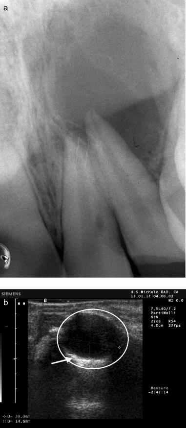Advanced radiographic techniques for the detection of lesions in bone Fig. 17. Ultrasound real-time imaging of a lesion of endodontic origin in the mandible.