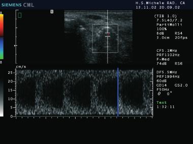 Cotti & Campisi Fig. 18. Picture representing the echo color power Doppler applied to the echographic examination of the previous case.