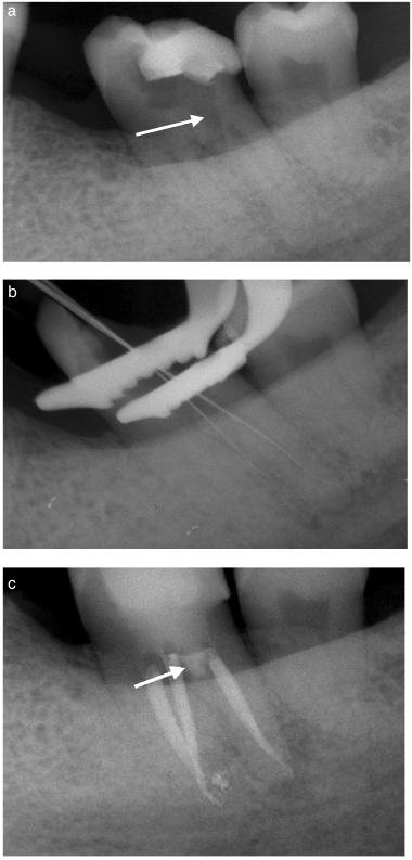 Advanced radiographic techniques for the detection of lesions in bone clinician towards a diagnosis of the soft tissue characteristics of the lesions (5).