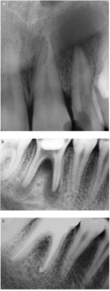 Cotti & Campisi techniques related to CT in the dental field: dental CT, ortho CT, local CT, tomosynthesis and tuned aperture computed tomography (TACT), and micro-ct.