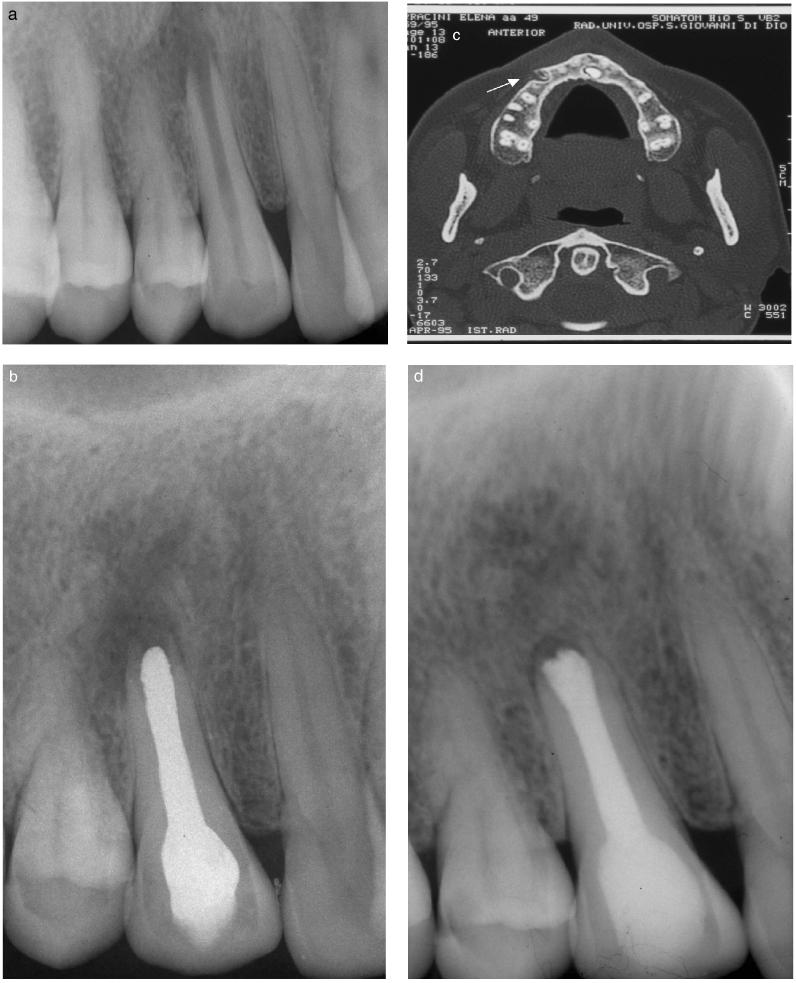 Cotti & Campisi Fig. 7. Endodontic lesion in the periapical area of the upper right canine.