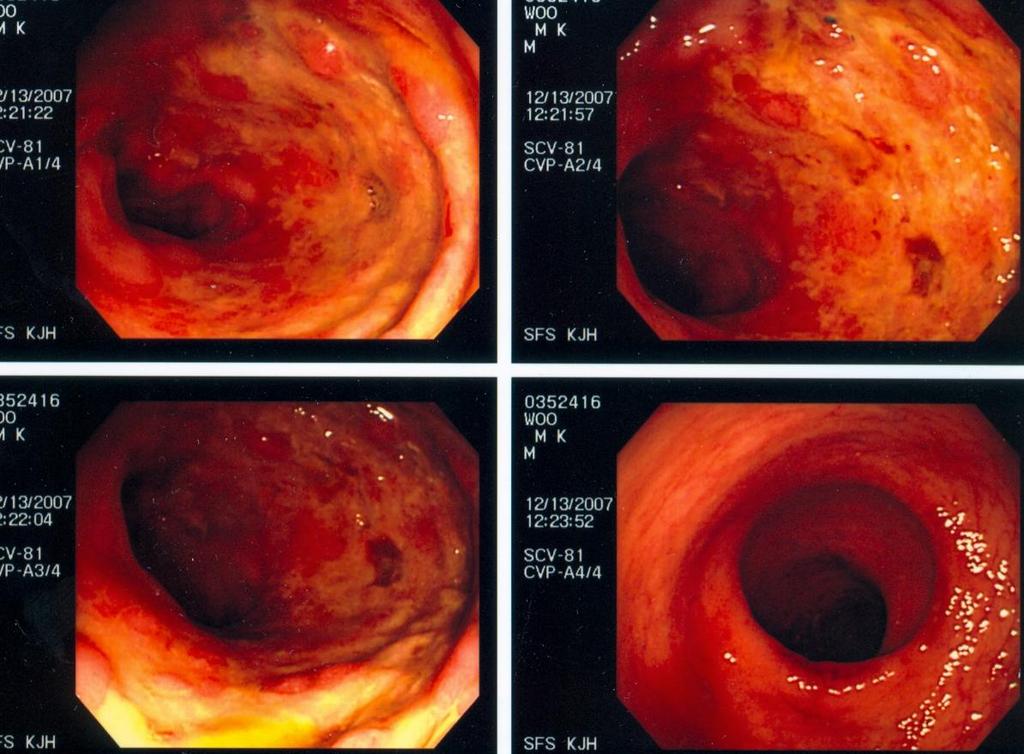 One week after the initial sigmoidoscopy