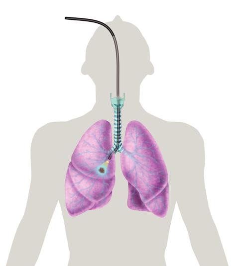Tissue collection techniques include: Bronchoscopy During a bronchoscopy, your doctors will insert a bronchoscope (a thin, flexible tube) into your mouth or nose, down the trachea, and into the lungs.