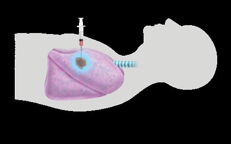 Endobronchial ultrasound-guided transbronchial needle aspiration (EBUS-TBNA) Your doctors may use EBUS-TBNA to access mediastinal lymph nodes.