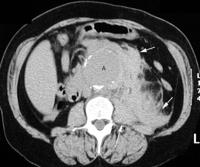 What is the arrow pointing to in CT scan? What is CT scan depicting?
