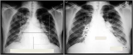 Pre Transplant Chest X ray Comment on the