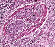 Esophageal & Gastroesophageal Junction Cancer N ation-wide an estimated 37,6 new upper gastrointestinal (GI) cancers originating in the esophagus, the gastroesophageal (GE) junction, and stomach, are