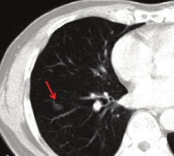 A B C D E F Fig. 1. (A) Computed tomography scan of the chest showing a solid nodule with a speculated margin (arrow) measuring 1.5-cm in size in the lower lobe of the right lung.