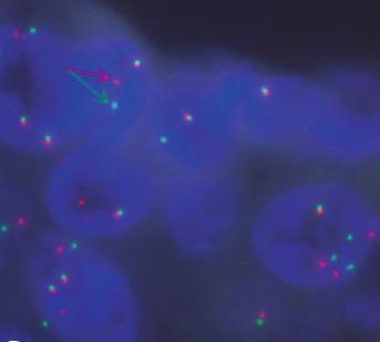 (C) Fluorescence in situ hybridization assay of ALK showing ALK genomic rearrangement by split 5!- and 3!-probe signals (arrows). (D-F) Hematoxylin and eosin staining showing adenocarcinoma (D,!