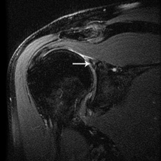 MRI for Detection of Labral Tears Fig. 1 47-year-old man with shoulder pain.