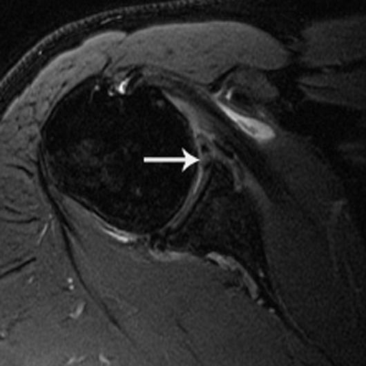 anteroposterior (SLP) tear (arrow). Patient had surgically proven SLP tear. Fig. 2 38-year-old man with shoulder instability.