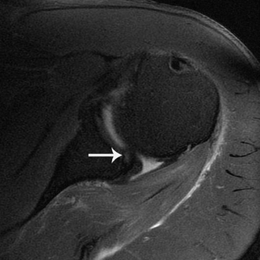 (arrow). Patient had surgically proven anterior labral tear. Fig. 3 35-year-old man with shoulder pain and instability.