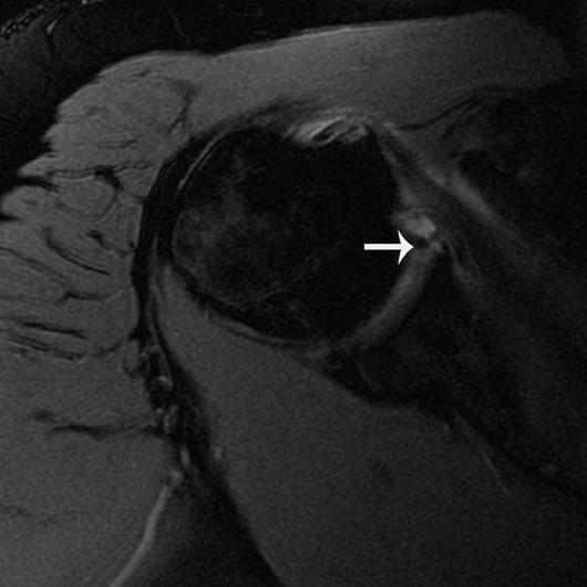 (arrow). Patient had surgically proven posterior labral tear. Fig. 4 28-year-old man with shoulder instability.  (arrow).