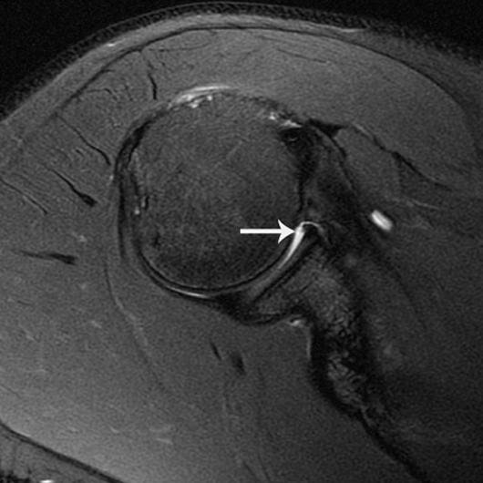 MRI for Detection of Labral Tears Fig. 7 24-year-old man with shoulder pain and instability.
