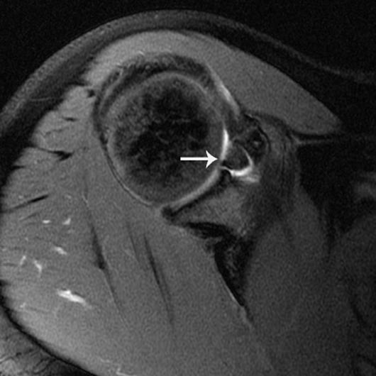 Patient had surgically proven anterior labral tear. Results Of the 67 patients who went on to arthroscopy, 42 patients had a total of 46 labral tears. Twenty-one patients had SLP tears.