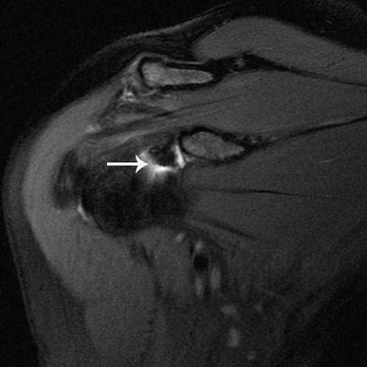 Three patients had both a SLP tear and an anterior labral tear, and one patient had a SLP tear and a posterior labral tear.