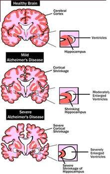 MAIN TYPES OF DEMENTIA ALZHEIMER S DISEASE, VASCULAR DISEASE, LEWY BODY DEMENTIA, PARKINSON S DISEASE WITH DEMENTIA, FRONTOTEMPORAL DEMENTIA, HIPPOCAMPAL SCLEROSIS OF AGING, PRIMARY TAUOPATHY COMMON