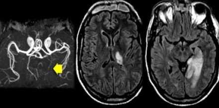 the stroke or blood vessel narrowing occurs Head