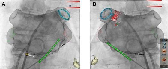 Fluoroscopy integrated 3 D mapping (randomized, single blind and controlled study) 60 PAF