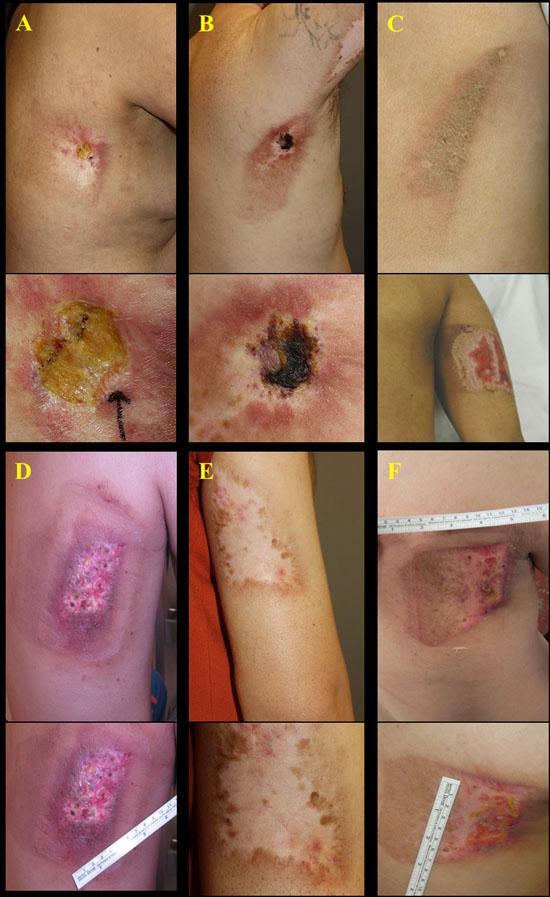 Radiation-induced Dermatitis 1347 patients