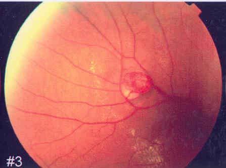 Diagnosis Diagnosis is primarily clinical. Dilated retinal exam Dilated tortuous vessels leading to and away of the vascular tumor.